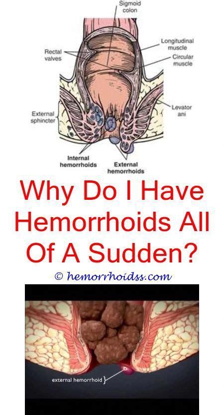 Will An Internal Hemorrhoid Go Away Why Are Hemorrhoids Worse At Nightwhat Are Hemorrho