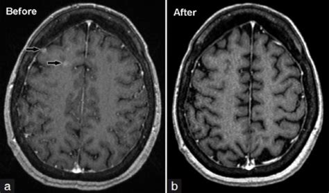 Magnetic Resonance Imaging Of The Brain Before A And After Erlotinib