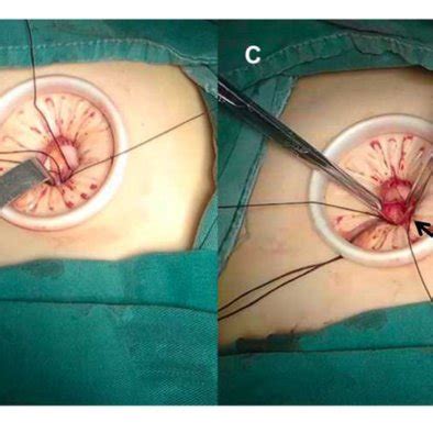 Anatomical Overview Of Para Aortic Area A Lymphadenectomy Up To