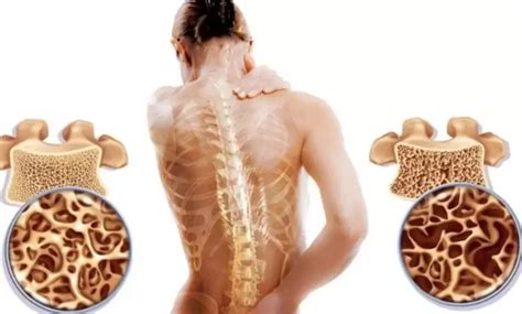 Langkah Praktis Mencegah Osteoporosis Sehat Tulang Sejahtera Hidup