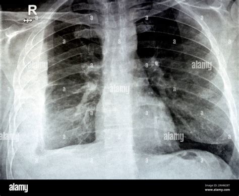 Chest Xray Pleural Effusion