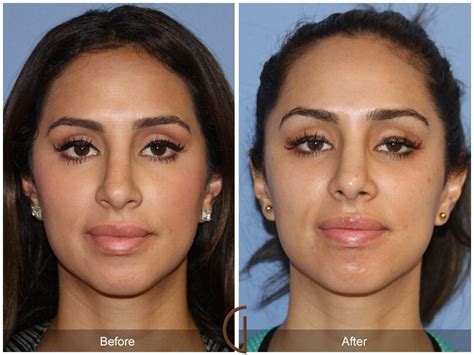 Female Rhinoplasty Before After Photos Patient Dr Kevin Sadati