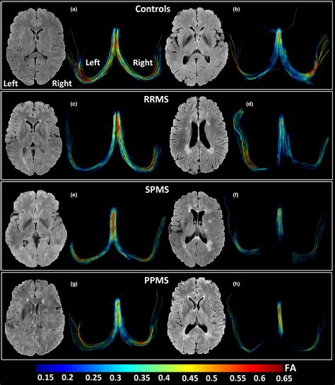 Fornix Mri