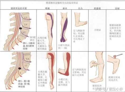 「腰椎間盤突出症」到底該不該手術？別讓錯誤「毀」了你的腰！ 每日頭條