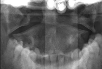 Bone And Joint Exam Fracture And Trauma Review Flashcards Quizlet