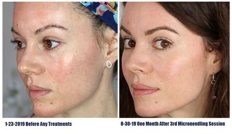 Microneedling Scottsdale At Top Rated Medspa BabyFace Top Rated