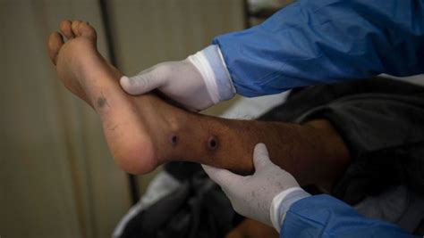 British scientists launch monkeypox treatment study