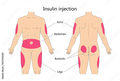 Insulin Injection Infographic Vector Diabetes Treatment And Insulin