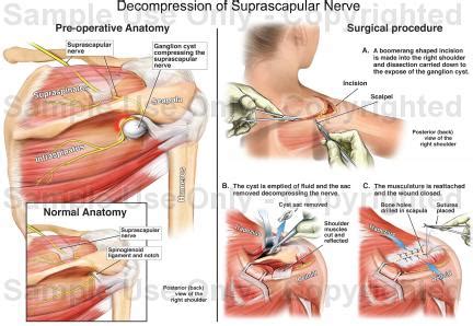 Decompression Of Suprascapular Nerve Medical Illustration Human