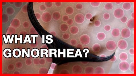 What Is Gonorrhea Health Risks Transmission Pictures And Symptoms