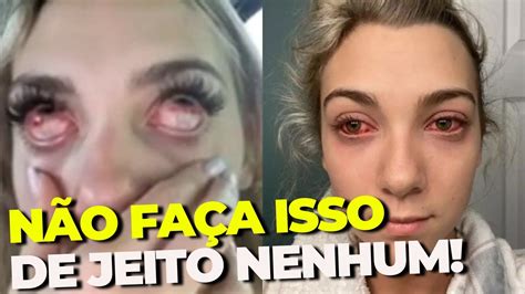 Olho Irritado Após Colocar Cílios O Que Fazer - IRRITAÇÃO ou ALERGIA após Extensão de Cílios... O que Fazer caso ocorra ...