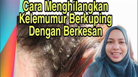 Cara Menghilangkan Kelemumur Di Rambut David Davies