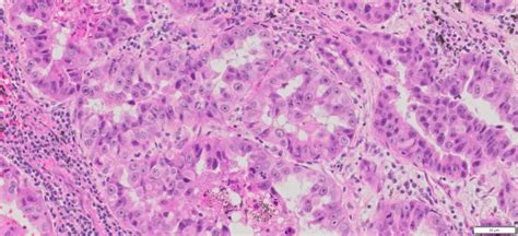 Human Lung Adenocarcinoma FFPE Sections