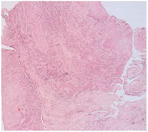 Vessels present in epithelium and subepithelial cells, CD34-tryptase ...