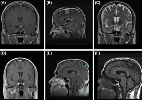 Surgical Management Of Pituitary Apoplexy Clinical Tree