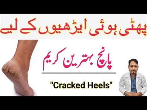 Cracked Heels Solution In Urdu Hindi Best Creams For Cracked Heels