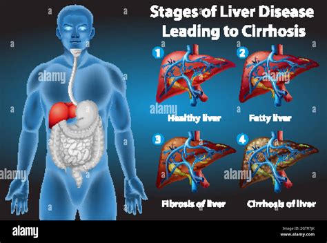 Stages of liver disease Stock Vector Image & Art - Alamy