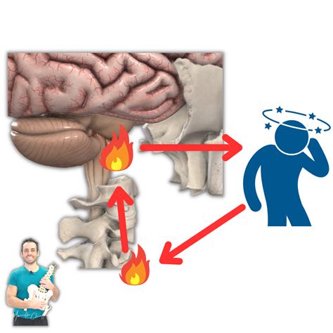 Cervicale E Sintomi Neurologici Quali Sono Ed Esercizi Mirati