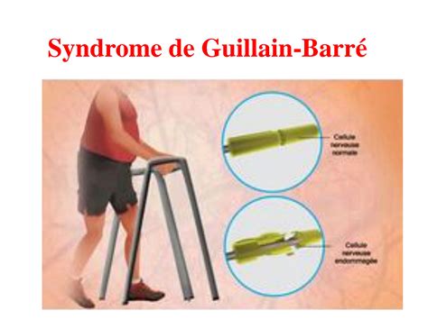 Solution Syndrome De Guillain Barr Studypool