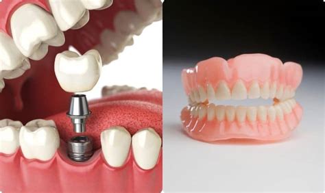 Key Differences Between Dental Implants And Dentures