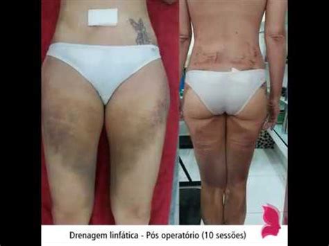 Drenagem linfática pós operatória Lipoaspiração e silicone YouTube