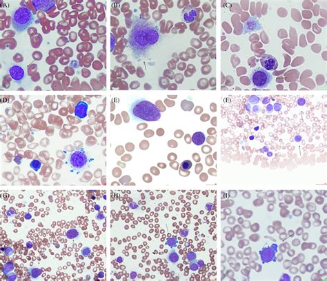 Pleomorphic Circulating Megakaryocytes In A Case Of CALR Positive