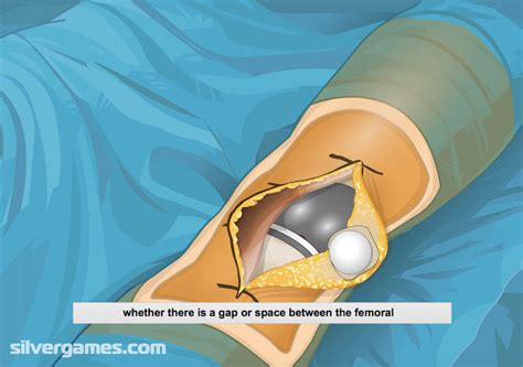 Virtual Knee Surgery Graj Online Na Silvergames