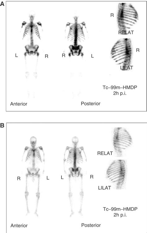 A) Bone scan of a 71-year-old patient with bone metastases induced by... | Download Scientific ...