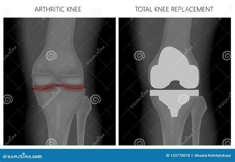 Knee Joint Bursitis Infographics Cartoon Vector CartoonDealer