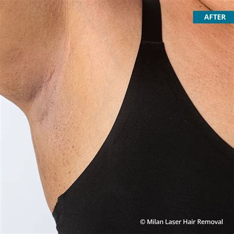 Underarm Before After Photos Of Laser Hair Removal Milan Laser