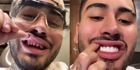 Kevinho Exibe Dentes Sem Lente De Contato E Vira Meme R Dio Nn