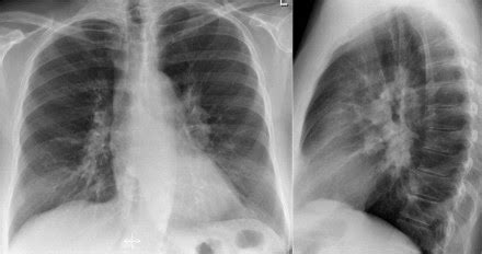 Chest Medicine Made Easy Dr Deepu Chest X Ray Part Normal Anatomy