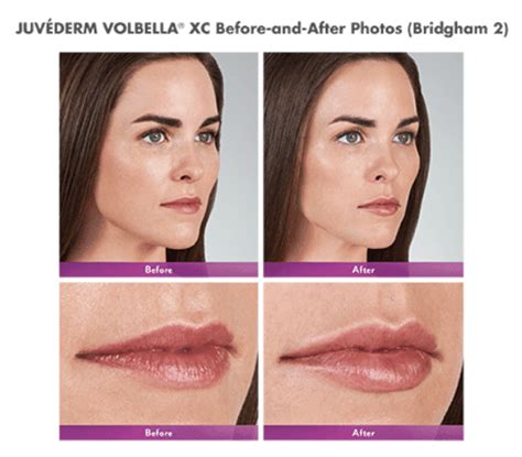 Juvederm Volbella® Xc Advanced Specialty Care