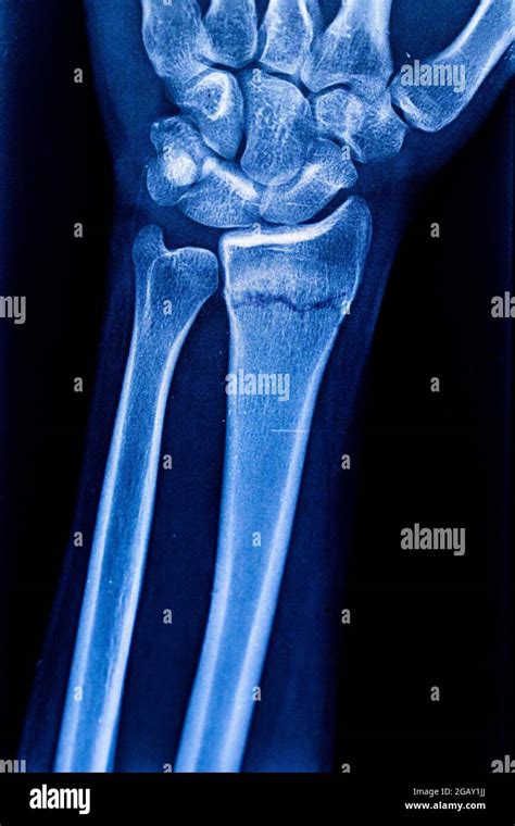 Examen Radiográfico De Fractura De Radio Rayos X Brazo Humano