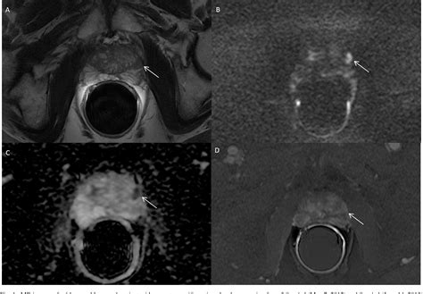 Figure 1 From Multiparametric Magnetic Resonance Imaging Vs Standard