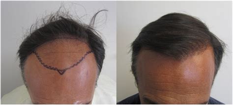 Hair Transplant Los Angeles | Dr. Sean Behanm