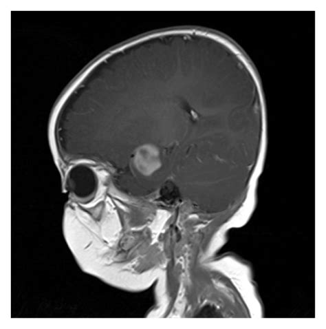 A Axial T1 Precontrast B Axial T1 Postcontrast C Sagittal T1