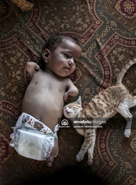 Congenital amputee child of Syrian family | Anadolu Images