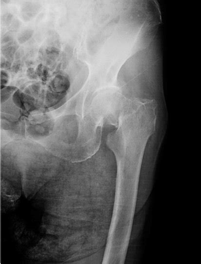 Transcervical Femoral Neck Fracture