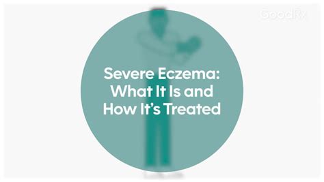 Severe Eczema (Atopic Dermatitis): What It Is and How It’s Treated - GoodRx