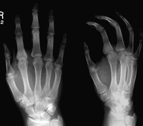 Septic Arthritis Hand