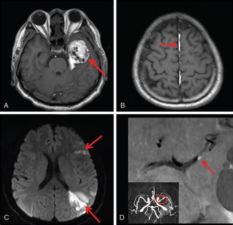 Intracranial Dermoid Cyst Rupture Related Brain Ischemia Ca Medicine