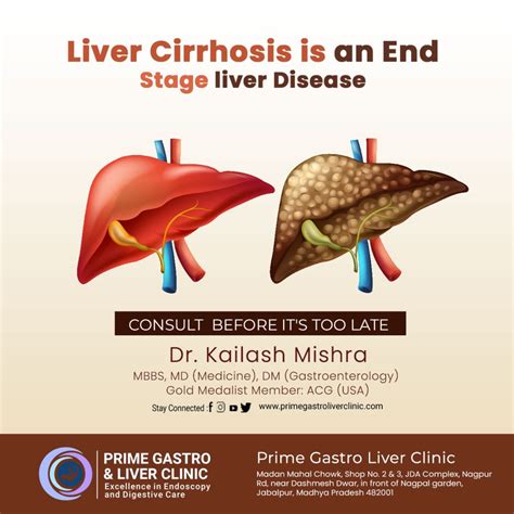 What is Liver Cirrhosis, Causes, Symptoms, Diagnosing, Treatment & More