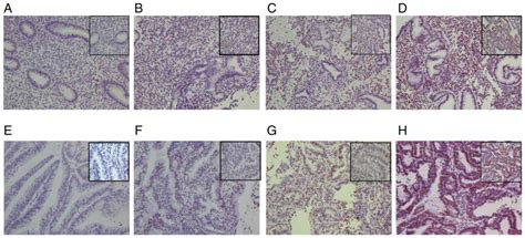 Bmi Promotes Invasion And Metastasis In Endometrial Adenocarcinoma