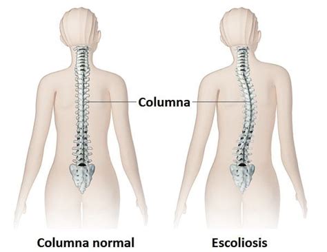 Escoliosis José Luis Vázquez