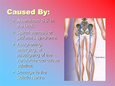 Ppt Sciatica Powerpoint Presentation Free Download Id2368997