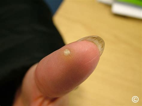 Wart On Finger