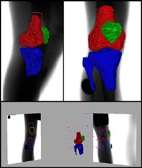 Medial Meniscal Posterior Horn Suturing Influences Tibial Internal