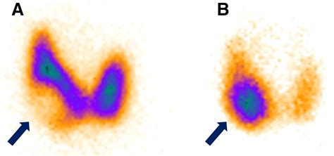 Molecular Imaging For Thyrotoxicosis And Thyroid Nodules Journal Of