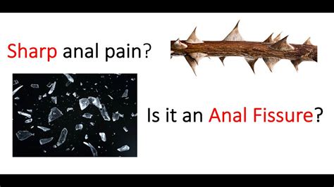 Sharp Stabbing Pain In Your ANUS Could It Be An Anal Fissure YouTube